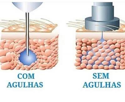 Lipo Enzimática Pressurizada com e sem agulha